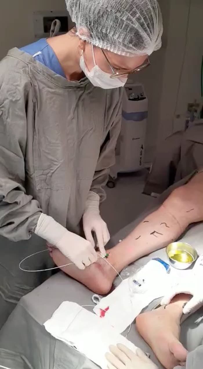 Cirurgia de Varizes a Laser em Itapetininga