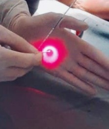Cirurgia de Varizes a Laser em Tatuí