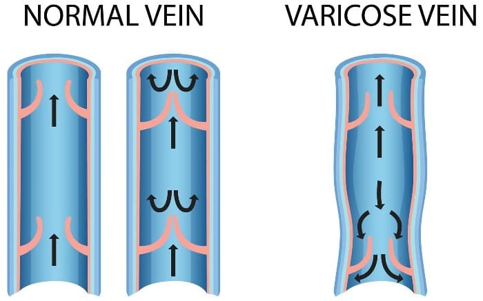 Cirurgia de Varizes em Sorocaba