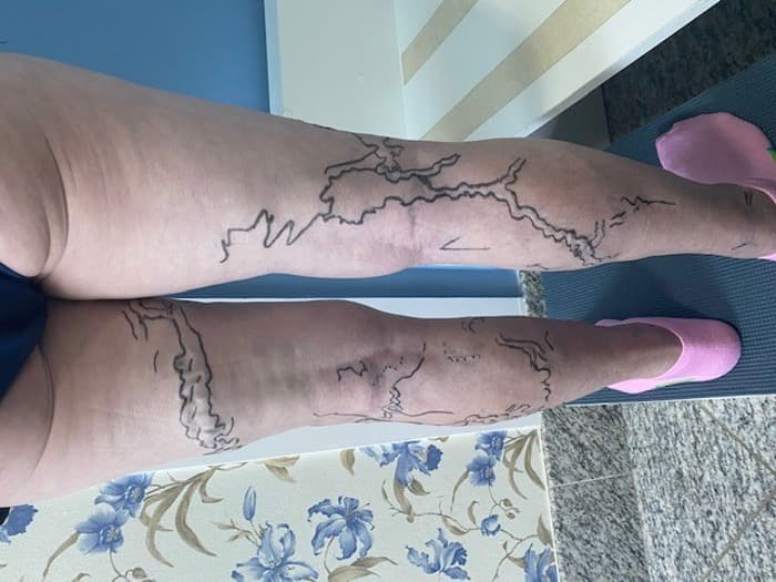 Cirurgia de Varizes em Tatuí