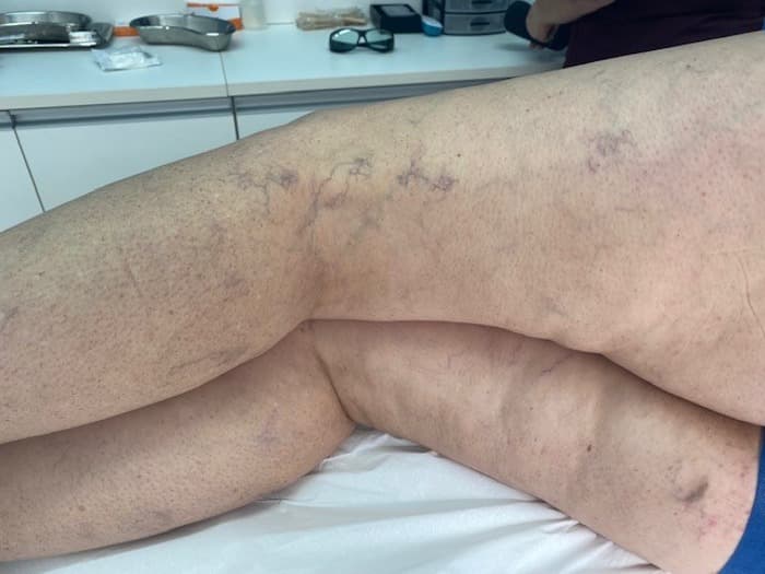 Clinica para Tratamento de Vasinhos em Tatuí