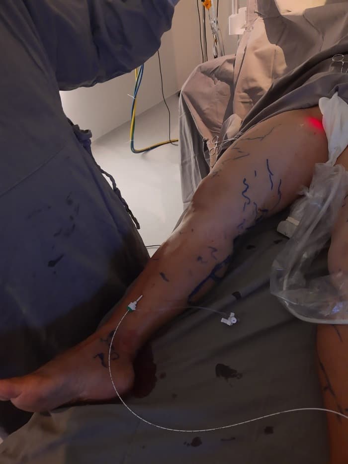 Tratamento a Laser de Varizes em Sorocaba
