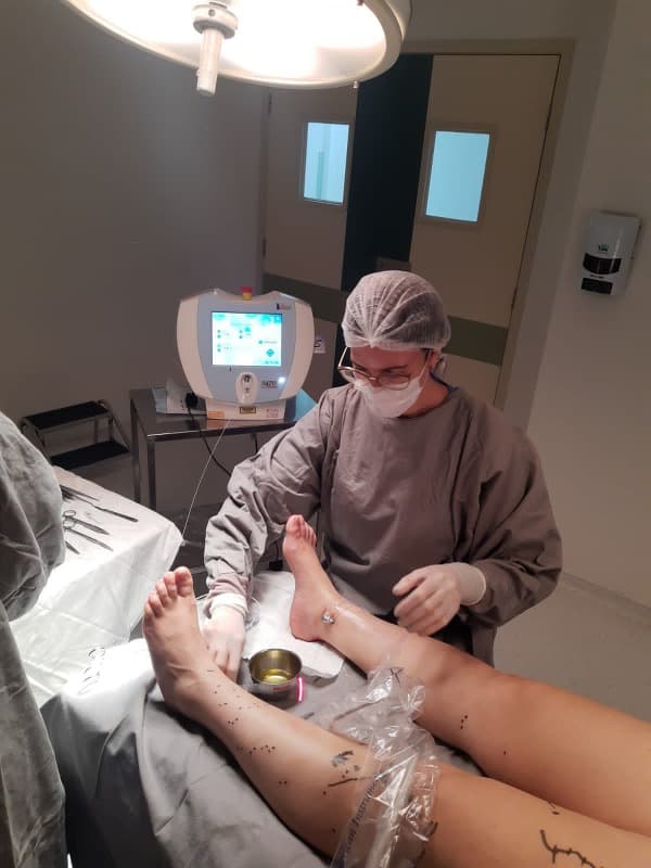 Tratamento a Laser para Varizes em Itapetininga