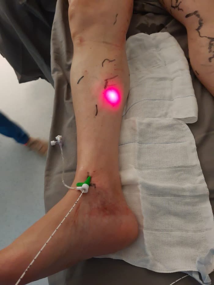 Tratamento a Laser para Varizes em Tatuí